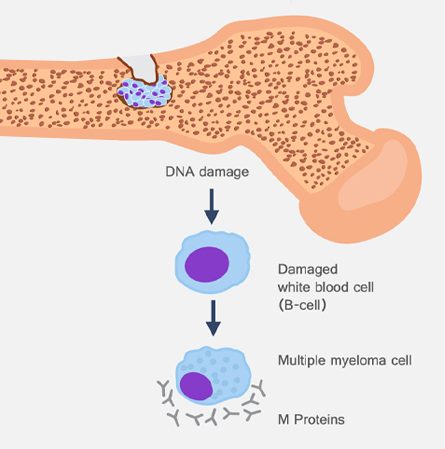Stem Cell Therapy Multiple Myeloma