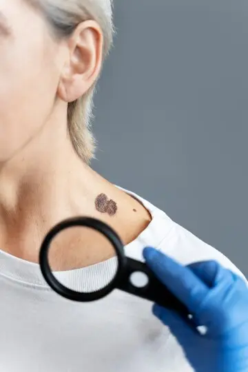 Melanoma and lung cancer - Stem Cell therapy - mesenchymal