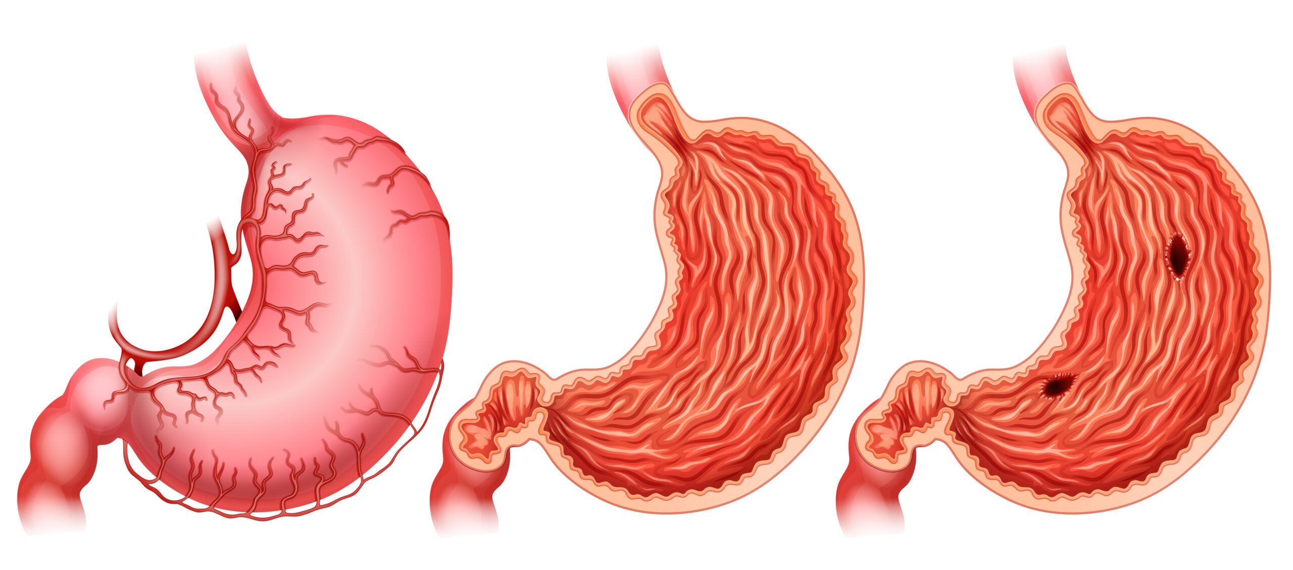 stem cells gastric cancer tijuana mexico